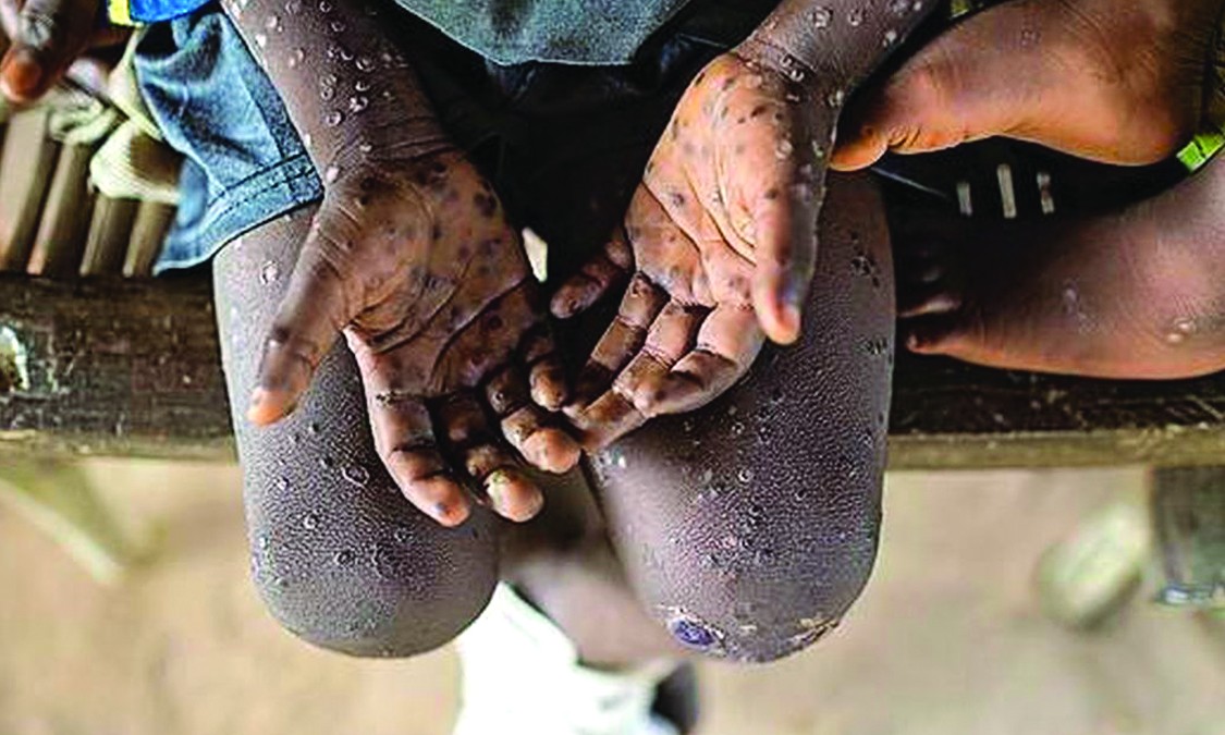 स्वास्थ्य मन्त्रालयले भन्यो – मङ्कीपक्स संक्रमणको जोखिममा नेपाल