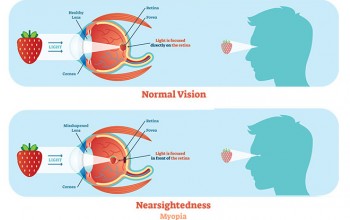 सावधान ! नेपालमा बढ्दैछ मायोपिया