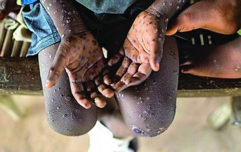 स्वास्थ्य मन्त्रालयले भन्यो – मङ्कीपक्स संक्रमणको जोखिममा नेपाल